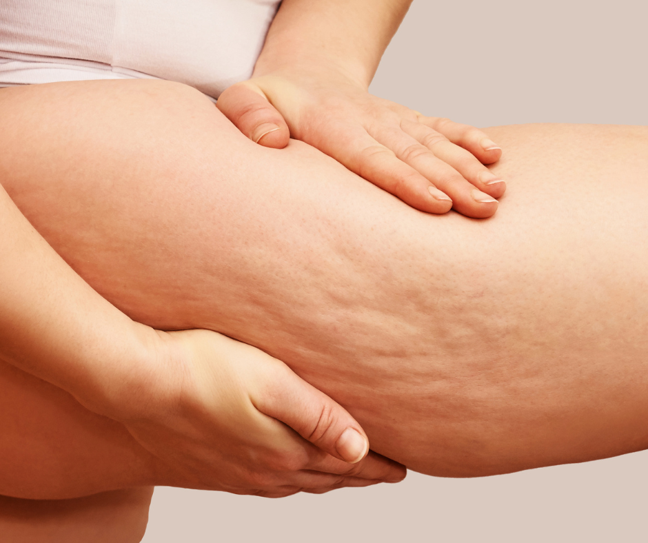 Cellulite reduction